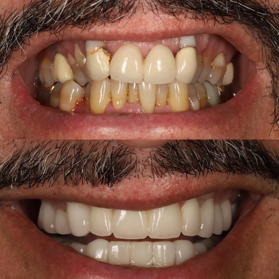 full mouth rehab smile gallery