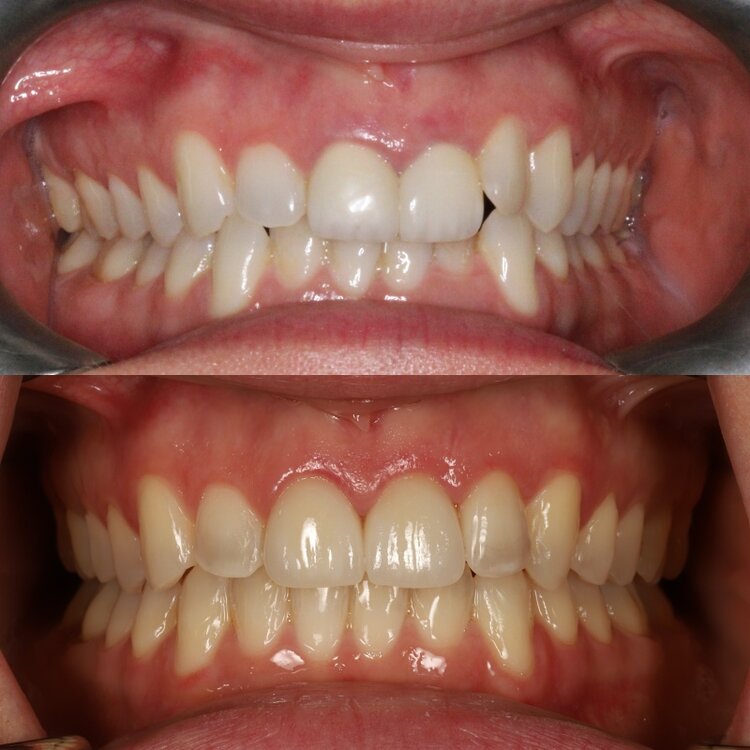 invisalign treatment 12 month smile gallery