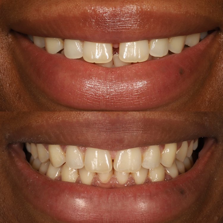 invisalign treatment 7 month smile gallery