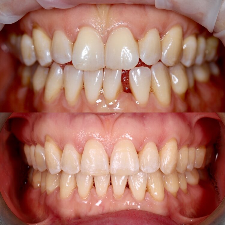 invisalign treatment 9 month smile gallery