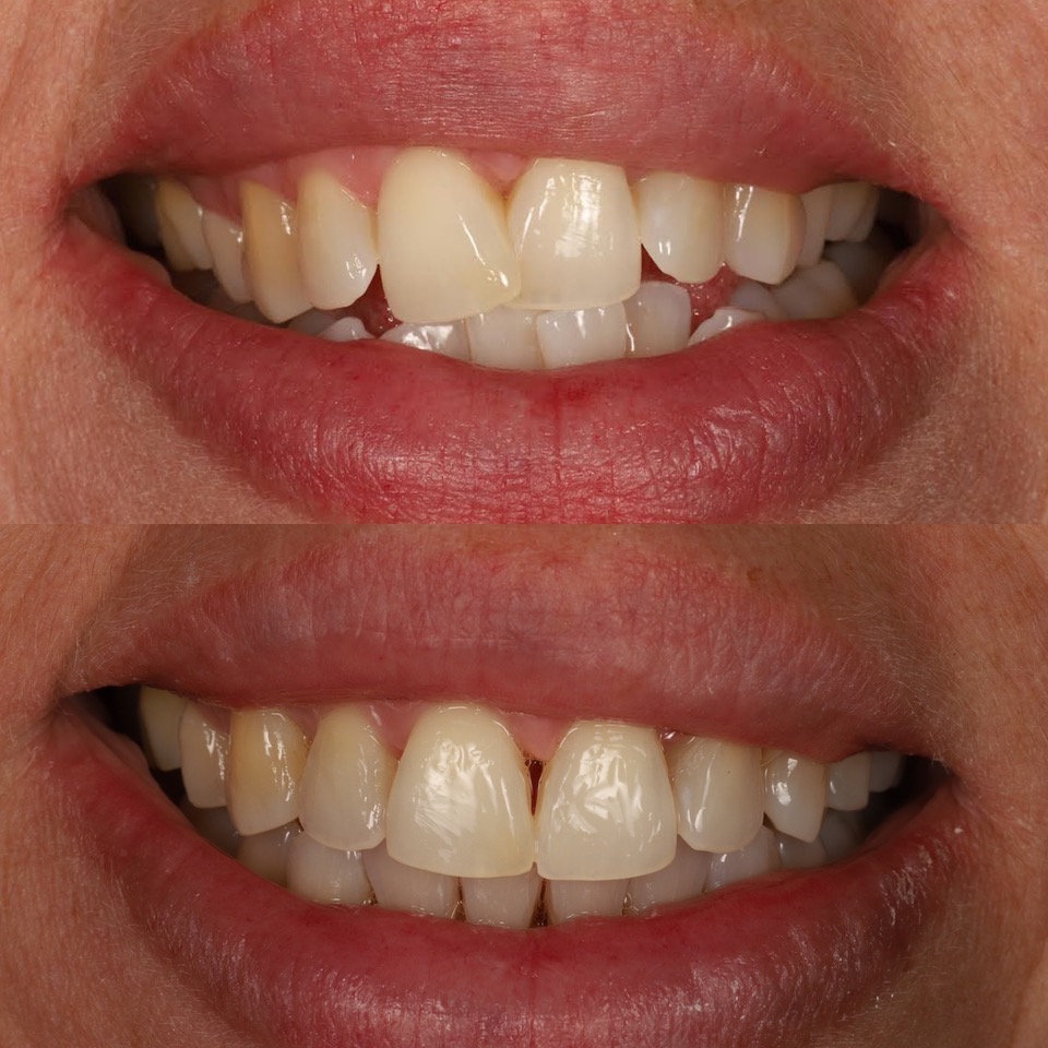 invisalign treatment smile gallery