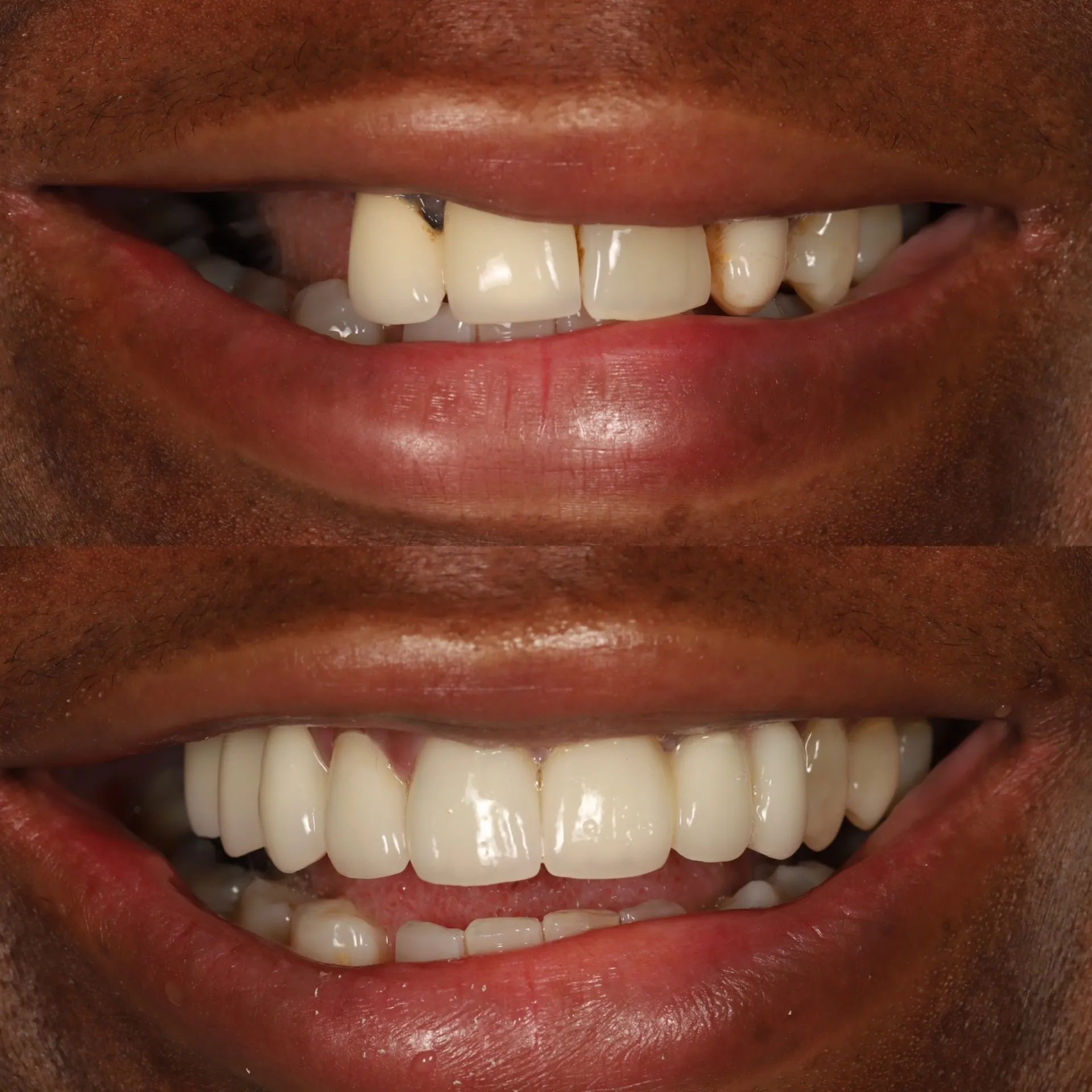 smile gallery upper rehab