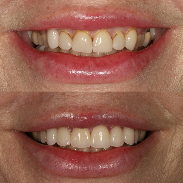 smile makeover smile gallery